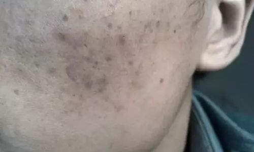 痘印黑色素沉淀怎么去除 痘印黑色素沉淀怎么去除