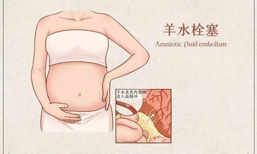 羊水栓塞是什么意思 羊水栓塞是什么意思